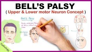 Bells palsy Upper and Lower Motor Neuron Lesions - Simplified