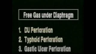 5.2. Intestinal Perforation Gas Under Diaphragm - Abdomen X-rays
