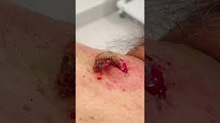 SATISFYING BACK CYST  PT 1