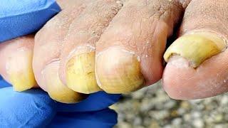 Patient has long toenails complete foot care【Podiatry Clinic】
