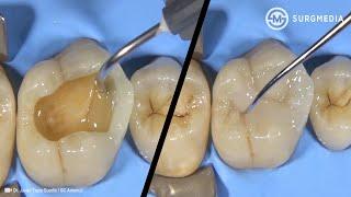 Step by Step Dental Filling Cavity Filling - Tooth Filling Cusp Build-Up of a Molar