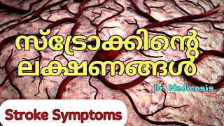 സ്ട്രോക്കിന്റെ ലക്ഷണങ്ങൾ  Stroke Symptoms  Dr. Medicosis