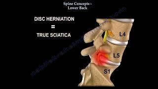 Low Back pain. Lumbar disc herniation causes diagnosis symptoms and treatment