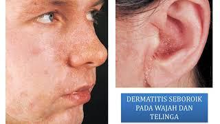 DERMATITIS SEBOROIK  Materi Kedokteran  Dermatologi