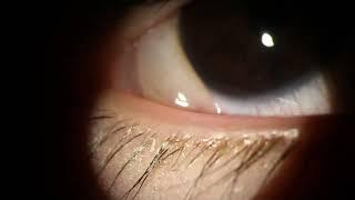 Chemosis - allergy blister on the white of the eye