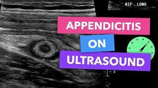 Appendicitis on ultrasound - Radiopaedias Emergency Radiology Course