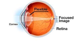 Mayo Clinic Minute Blurry vision as you age