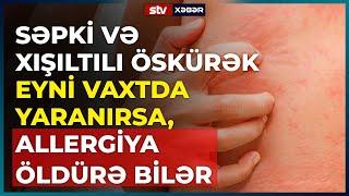 SƏPKİ VƏ XIŞILTILI ÖSKÜRƏK EYNİ VAXTDA YARANIRSA ALLERGİYA ÖLDÜRƏ BİLƏR