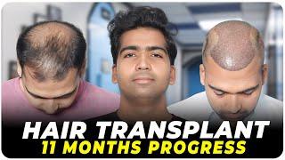 Hair Transplant in India  Best Results & Cost of Hair Transplant in India