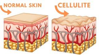 Cellulite Treatment - The difference between fat and cellulite