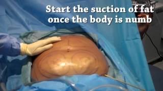 How is liposuction performed?  Tutorial  Centre for Surgery