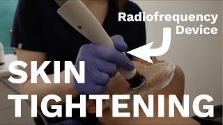 The BEST devices for Skin Tightening  Dr Davin Lim