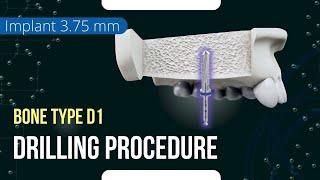 Drilling procedure for XGate Dental X11 and X3 Pure&Porous Implant 3.75 mm diameter bone type D1