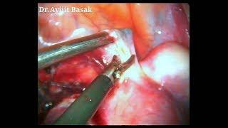 Fibroid Uterus  TLH BSO by Dr.Avijit Basak