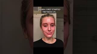 Tretinoin Transformation