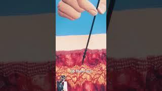 How To Remove Porcupine Quills #shorts #video #viral