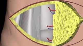 Breast Reconstruction - DIEP procedure Narration and Animation by Cal Shipley M.D.