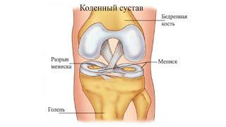 Несколько тестов для оценки работы мениска. Коленный сустав