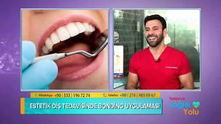Estetik Diş Tedavisinde Bonding Uygulaması
