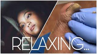 Relaxing Diabetic Toe Nail Cutting