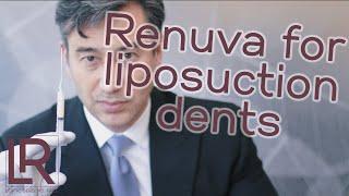 Renuva Fills In Dents from Liposuction  Dr. Leif Rogers