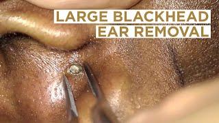 Large blackhead removed from the ear  Dr Cameron McIntosh