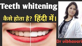 दांतों को सफेद कैसे करें? Teeth whitening Bleaching हिंदी में