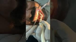 #shorts 6 Advantages of Dental Cleaning and Scaling  Read Description....