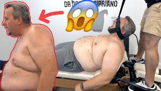 SEVERE HYPERKYPHOSIS HUNCHBACK *Pain & Immobility* Chiropractic Cracking by Dr Cipriano