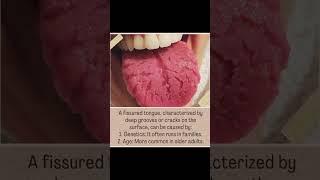 Fissured Tongue. Did you know? Feedingbrain.