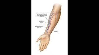 Arteriovenous Fistula #healthcare #health