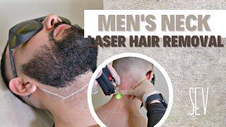 Neck Laser Hair Removal for Men