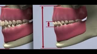 Les dégâts du BRUXISME - Serrage des dents trop fort et abrasif