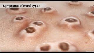 Mpox Monkeypox Animation
