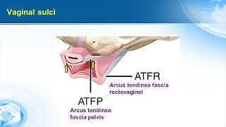 Pubourethral and urethropelvic ligaments plication rationale & tecnique