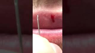 Fordyce spot on lip removal with needle 