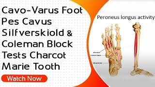 Cavo-Varus Foot  Pes Cavus  Silfverskiold & Coleman Block Tests  Charcot Marie Tooth