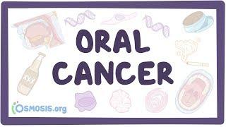 Oral Cancer - causes symptoms diagnosis treatment pathology