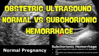 Obstetric Ultrasound Normal Vs Subchorionic Hemorrhage SCH  Early & Mid Pregnancy Bleeding USG
