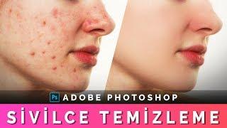 PHOTOSHOP SİVİLCE TEMİZLEME  Cilt Temizleme  Photoshop Acne Removal