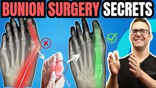 Bunion Surgery SECRETS & FAST Recovery Bunionectomy vs Lapiplasty