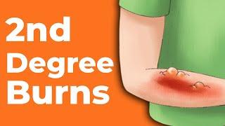 2nd Degree Burns How to Treat Them  Wound Care OC