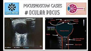 Ocular POCUS - измерение диаметра оболочки зрительного нерва. УЗИ глаза. #NeuroPOCUS #ICH