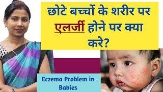 बच्चों को एलर्जी हो जाये तो क्या करें। Baby Eczema Problem Causes Symptoms And Treatments