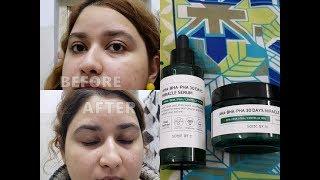 SOME BY MI AHA BHA PHA 30 Days Miracle Serum and Miracle Cream Review  Korean Skincare