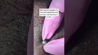 Ingrown hair saga # #satisfying #galaxyextractions #pimplepopping