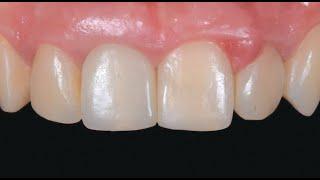 Immediate MIS V3 Guided Implant in Aesthetic Zone Combined with Ceramic Rehabilitation