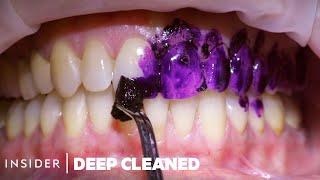 How Teeth Are Professionally Deep Cleaned  Deep Cleaned