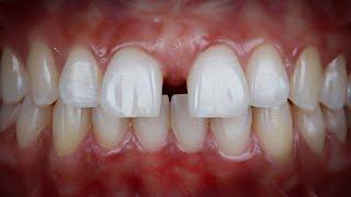 Niềng răng Invisalign trường hợp răng thưa  invisalign fix spacing teeth
