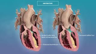 Tell Me More Hypertrophic Cardiomyopathy